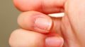 Как избавиться от заусенцев: простые советы и народные методы
