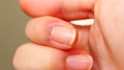 Как избавиться от заусенцев: простые советы и народные методы