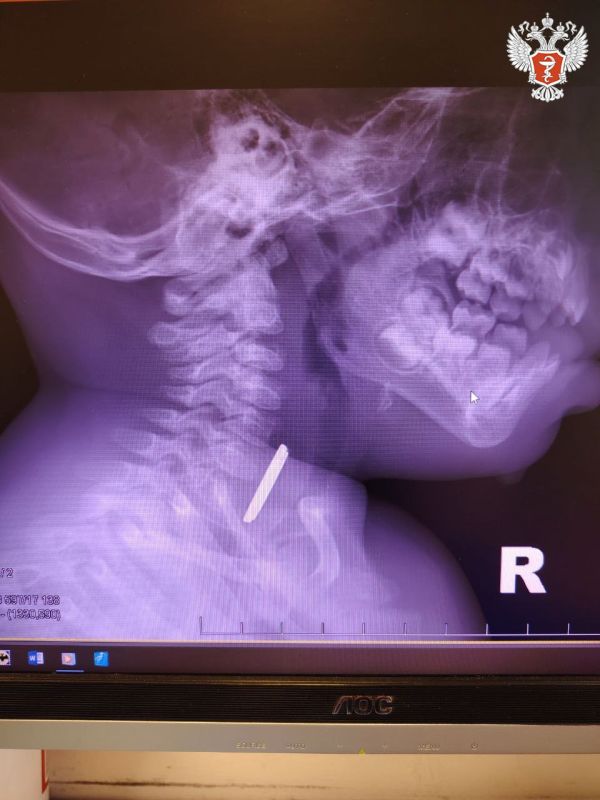 Ханты-Мансийские врачи спасли ребенка, проглотившего батарейку