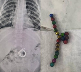 Двухлетний ребенок проглотил 19 магнитов и чуть не погиб