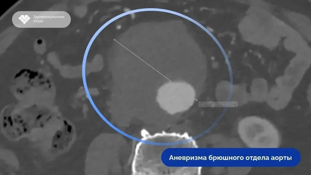 Сургутские рентгенхирурги выполнили сложную реконструкцию аорты 75-летнему пациенту